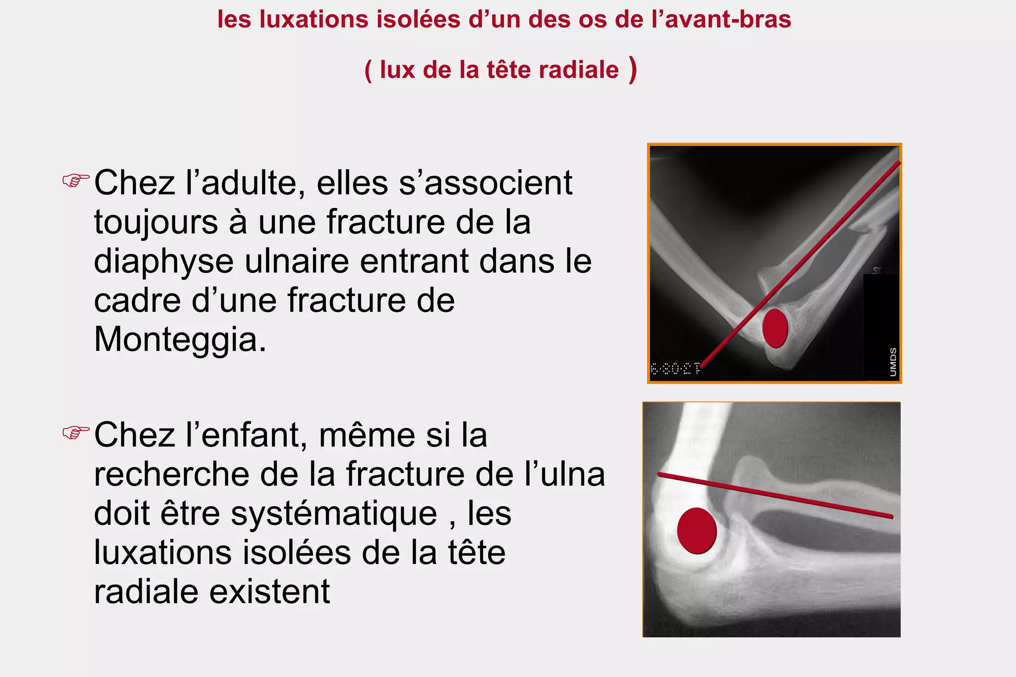 les luxations isolées d’un des os de l’avant-bras  ( lux de la tête radiale  )   Chez l’adulte, elles s’associent toujours à une fracture de la diaphyse ulnaire entrant dans le cadre d’une fracture de Monteggia.  Chez l’enfant, même si la recherche de la fracture de l’ulna doit être systématique , les luxations isolées de la tête radiale existent 