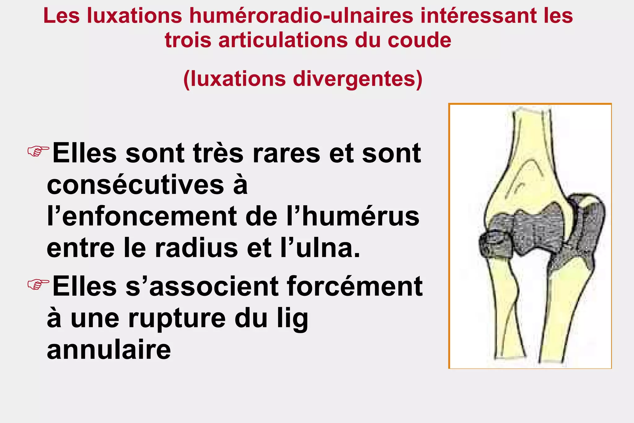 Les luxations huméroradio-ulnaires intéressant les trois articulations du coude (luxations divergentes)   Elles sont très rares et sont consécutives à l’enfoncement de l’humérus  entre le radius et l’ulna.  Elles s’associent forcément à une rupture du lig annulaire 