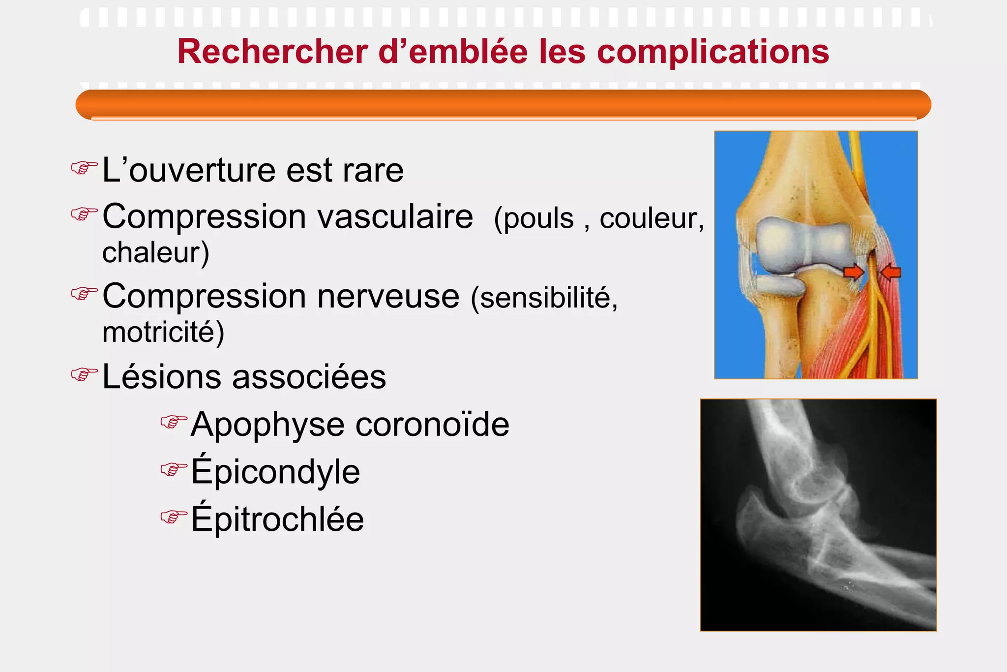 Rechercher d’emblée les complications L’ouverture est rare Compression vasculaire  (pouls , couleur, chaleur) Compression nerveuse  (sensibilité, motricité) Lésions associées Apophyse coronoïde Épicondyle Épitrochlée 