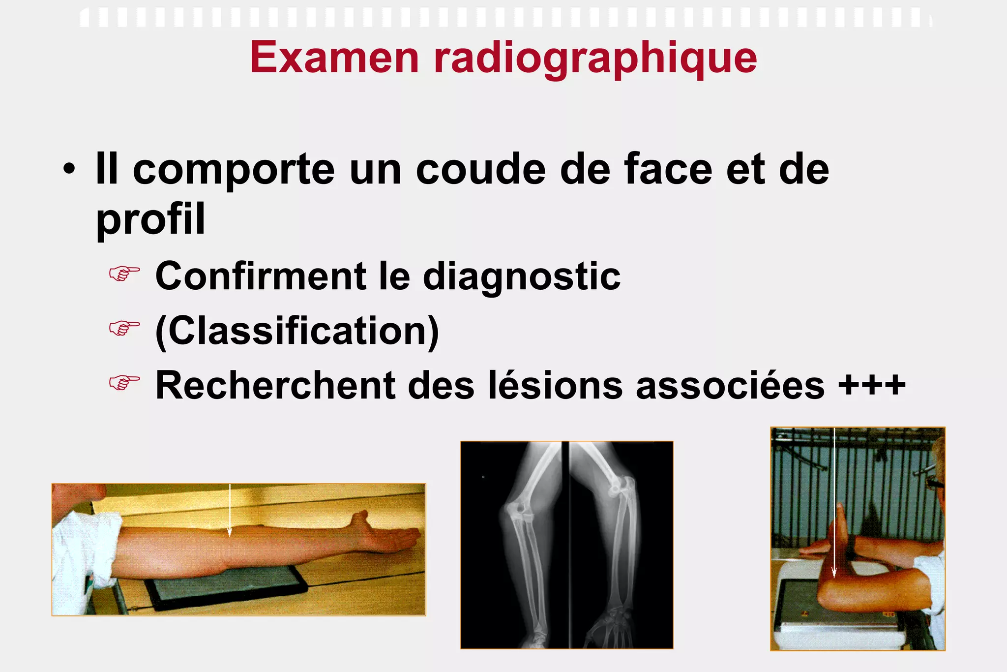 Examen radiographique Il comporte un coude de face et de profil Confirment le diagnostic (Classification) Recherchent des lésions associées +++ 