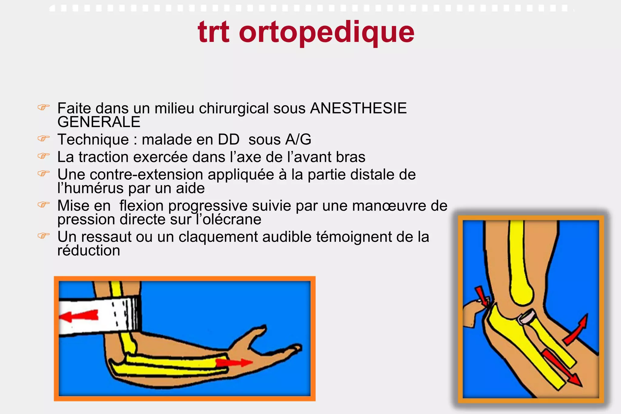 trt ortopedique  Faite dans un milieu chirurgical sous ANESTHESIE GENERALE Technique : malade en DD  sous A/G  La traction exercée dans l’axe de l’avant bras  Une contre-extension appliquée à la partie distale de l’humérus par un aide  Mise en  flexion progressive suivie par une manœuvre de pression directe sur l’olécrane  Un ressaut ou un claquement audible témoignent de la réduction 