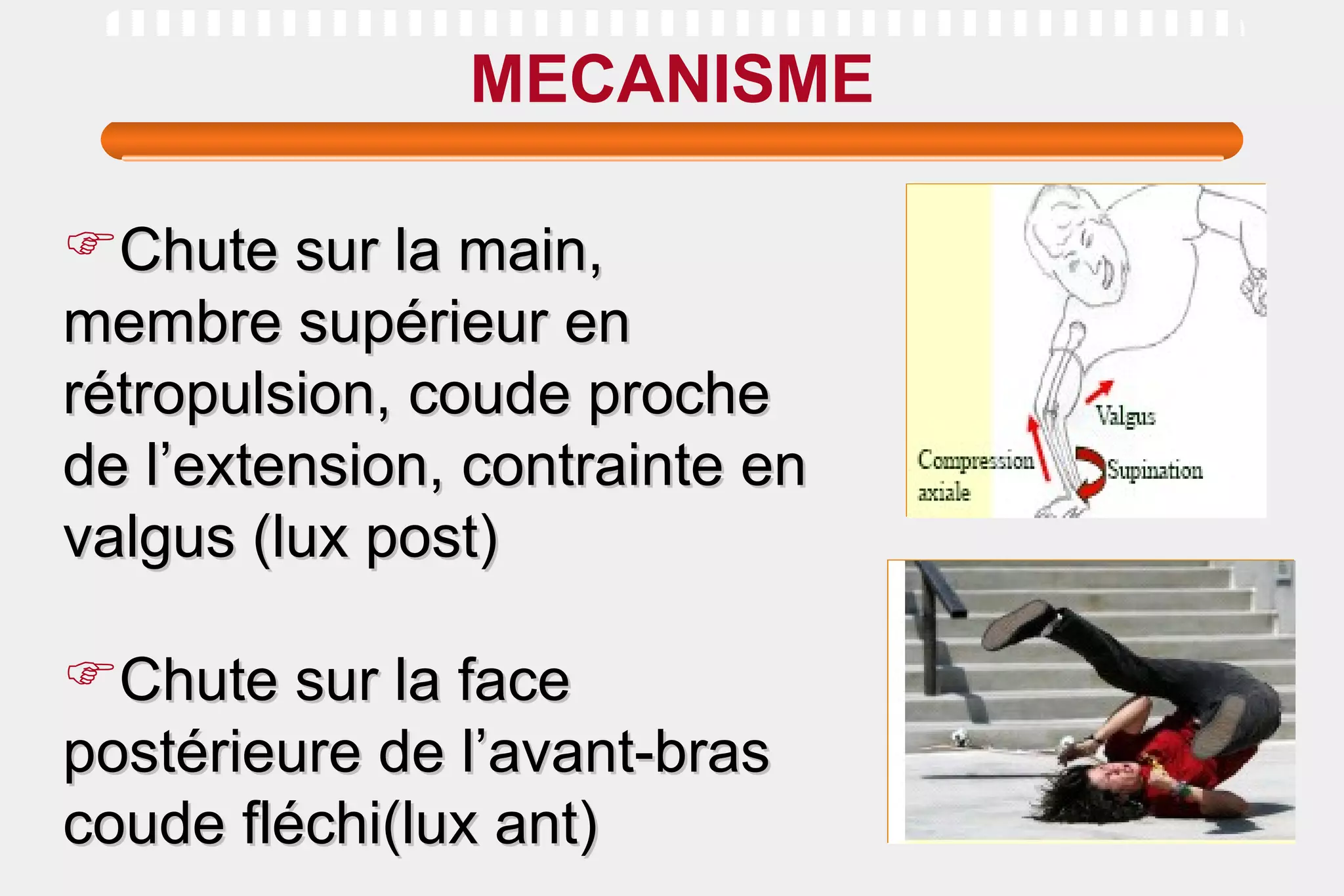 MECANISME Chute sur la main, membre supérieur en  rétropulsion, coude proche de l’extension, contrainte en valgus (lux post) Chute sur la face postérieure de l’avant-bras coude fléchi(lux ant) 