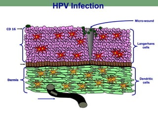 HPV Infection
Langerhans
cells
Dendritic
cells
Dermis
Micro-wound
Epidermis
Draining lymphatics
Basement
membrane
CD 16
 