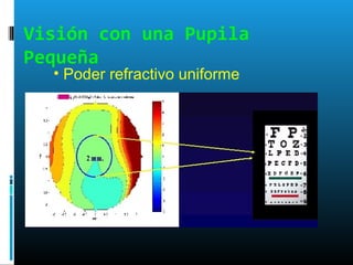 Visión con una Pupila
Pequeña
• Poder refractivo uniforme
 