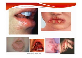 MOUFFOK N, herpes virus
 