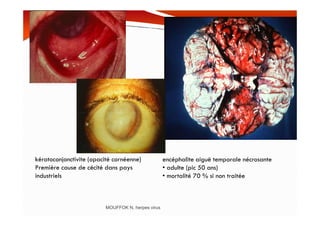 MOUFFOK N, herpes virus
encéphalite aiguë temporale nécrosante
• adulte (pic 50 ans)
• mortalité 70 % si non traitée
kératoconjonctivite (opacité cornéenne)
Première cause de cécité dans pays
industriels
 