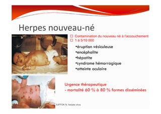 Herpes nouveau-né
•éruption vésiculeuse
•encéphalite
•hépatite
Contamination du nouveau né à l’accouchement
1 à 5/10 000
MOUFFOK N, herpes virus
•hépatite
•syndrome hémorragique
•atteinte oculaire
Urgence thérapeutique
- mortalité 60 % à 80 % formes disséminées
 