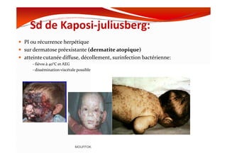 Sd de Kaposi-juliusberg:
PI ou récurrence herpétique
sur dermatose préexistante (dermatite atopique)
atteinte cutanée diffuse, décollement, surinfection bactérienne:
- fièvre à 40°C et AEG
- dissémination viscérale possible
MOUFFOK N, herpes virus
 