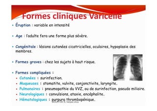 Formes cliniques Varicelle
Éruption : variable en intensité
Age : l’adulte fera une forme plus sévère.
Congénitale : lésions cutanées cicatricielles, oculaires, hypoplasie des
membres.
Formes graves : chez les sujets à haut risque.
Formes compliquées :
Cutanées : surinfection.
Muqueuses : stomatite, vulvite, conjonctivite, laryngite.
Pulmonaires : pneumopathie du VVZ, ou de surinfection, pseudo miliaire.
Neurologiques : convulsions, ataxie, encéphalite.
Hématologiques : purpura thrombopénique.
MOUFFOK N, herpes virus
 