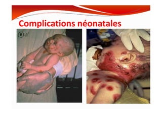 Complications néonatales
 