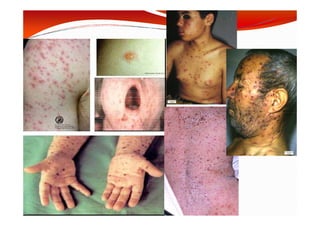 MOUFFOK N, herpes virus
 