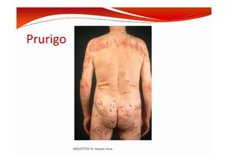 Prurigo
MOUFFOK N, herpes virus
 