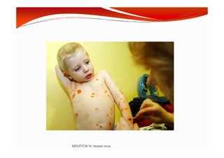 MOUFFOK N, herpes virus
 
