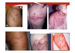 MOUFFOK N, herpes virus
 