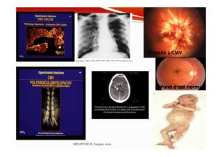 Rétinite à CMV
MOUFFOK N, herpes virus
Fond d’œil normal
 