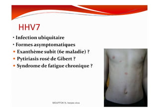 HHV7
• Infection ubiquitaire
• Formes asymptomatiques
Exanthème subit (6e maladie) ?
Pytiriasis rosé de Gibert ?Pytiriasis rosé de Gibert ?
Syndrome de fatigue chronique ?
MOUFFOK N, herpes virus
 