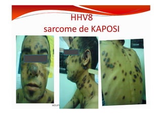 HHV8
sarcome de KAPOSI
MOUFFOK N, herpes virus
 
