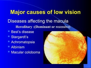 Major causes of low vision
Diseases affecting the macula
Hereditary :(Dominant or recessive)
 Best’s disease
 Stargardt’s
 Achromatopsia
 Albinism
 Macular coloboma
 