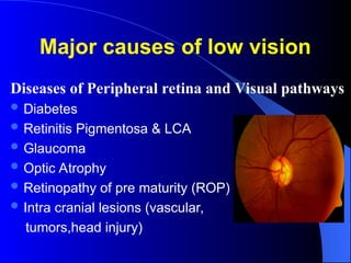 Major causes of low vision
Diseases of Peripheral retina and Visual pathways
 Diabetes
 Retinitis Pigmentosa & LCA
 Glaucoma
 Optic Atrophy
 Retinopathy of pre maturity (ROP)
 Intra cranial lesions (vascular,
tumors,head injury)
 