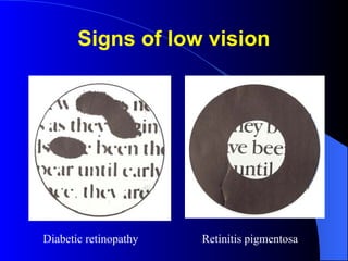 Signs of low vision
Diabetic retinopathy Retinitis pigmentosa
 