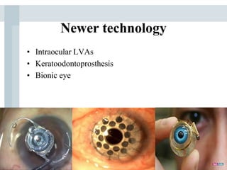 Newer technology
• Intraocular LVAs
• Keratoodontoprosthesis
• Bionic eye
 