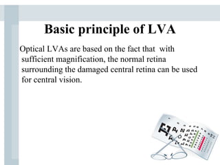 Basic principle of LVA
Optical LVAs are based on the fact that with
sufficient magnification, the normal retina
surrounding the damaged central retina can be used
for central vision.
 