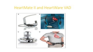 HeartMate II and HeartWare VAD
 
