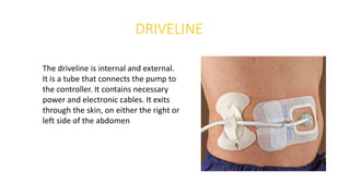 DRIVELINE
The driveline is internal and external.
It is a tube that connects the pump to
the controller. It contains necessary
power and electronic cables. It exits
through the skin, on either the right or
left side of the abdomen
 