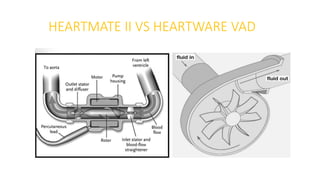 HEARTMATE II VS HEARTWARE VAD
 
