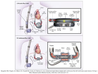 Slaughter MS, Rogers JG, Milano CA, Russell SD, Conte JV, Feldman D, et al. Advanced heart failure treated with continuous-ﬂow left ventricular assist device. N Engl J
Med. Massachusetts Medical Society; 2009 Dec 3;361(23):2241–51.
 
