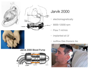 Jarvik 2000
• electromagnetically 

• 8000-12000 rpm

• Flow 7 ml/min

• implanted at LV

• outﬂow Des thoracic Ao
 