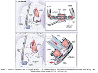 Rogers JG, Pagani FD, Tatooles AJ, Bhat G, Slaughter MS, Birks EJ, et al. Intrapericardial left ventricular assist device for advanced heart failure. N Engl J Med.
Massachusetts Medical Society; 2017 Feb 2;376(5):451–60.
 
