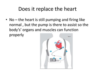Does it replace the heart
• No – the heart is still pumping and firing like
normal , but the pump is there to assist so the
body’s’ organs and muscles can function
properly