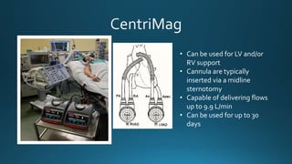 • Can be used for LV and/or
RV support
• Cannula are typically
inserted via a midline
sternotomy
• Capable of delivering flows
up to 9.9 L/min
• Can be used for up to 30
days
 