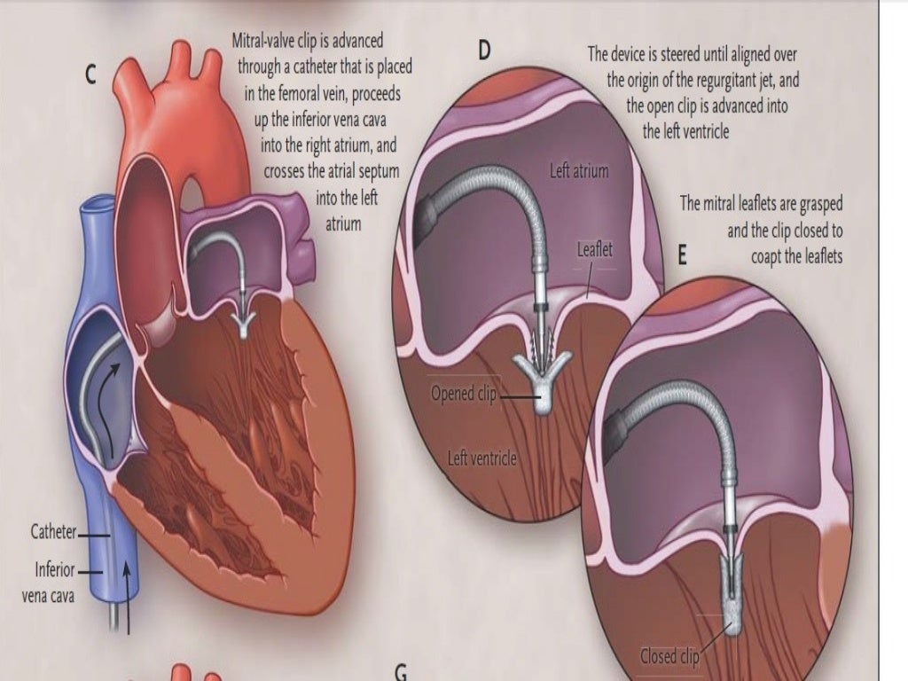 heart failure device therapy