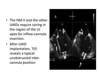 • The HM-II and the other
LVADs require coring in
the region of the LV
apex for inflow-cannula
insertion.
• After LVAD
implantation, TEE
reveals a typical
unobstructed inlet-
cannula position
 