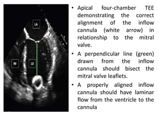 • Apical four-chamber TEE
demonstrating the correct
alignment of the inflow
cannula (white arrow) in
relationship to the mitral
valve.
• A perpendicular line (green)
drawn from the inflow
cannula should bisect the
mitral valve leaflets.
• A properly aligned inflow
cannula should have laminar
flow from the ventricle to the
cannula
 