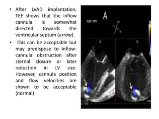 • After LVAD implantation,
TEE shows that the inflow
cannula is somewhat
directed towards the
ventricular septum (arrow).
• This can be acceptable but
may predispose to inflow-
cannula obstruction after
sternal closure or later
reduction in LV size.
However, cannula position
and flow velocities are
shown to be acceptable
(normal)
 