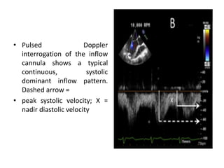 • Pulsed Doppler
interrogation of the inflow
cannula shows a typical
continuous, systolic
dominant inflow pattern.
Dashed arrow =
• peak systolic velocity; X =
nadir diastolic velocity
 
