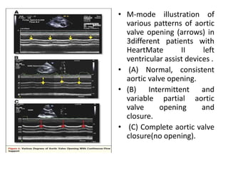 • M-mode illustration of
various patterns of aortic
valve opening (arrows) in
3different patients with
HeartMate II left
ventricular assist devices .
• (A) Normal, consistent
aortic valve opening.
• (B) Intermittent and
variable partial aortic
valve opening and
closure.
• (C) Complete aortic valve
closure(no opening).
 