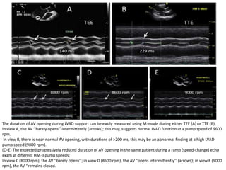 The duration of AV opening during LVAD support can be easily measured using M-mode during either TEE (A) or TTE (B).
In view A, the AV ‘‘barely opens’’ intermittently (arrows); this may, suggests normal LVAD function at a pump speed of 9600
rpm.
In view B, there is near-normal AV opening, with durations of >200 ms; this may be an abnormal finding at a high LVAD
pump speed (9800 rpm).
(C–E) The expected progressively reduced duration of AV opening in the same patient during a ramp (speed-change) echo
exam at different HM-II pump speeds:
In view C (8000 rpm), the AV ‘‘barely opens’’; in view D (8600 rpm), the AV ‘‘opens intermittently’’ (arrows); in view E (9000
rpm), the AV ‘‘remains closed.
 