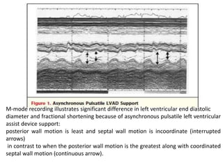 M-mode recording illustrates significant difference in left ventricular end diastolic
diameter and fractional shortening because of asynchronous pulsatile left ventricular
assist device support:
posterior wall motion is least and septal wall motion is incoordinate (interrupted
arrows)
in contrast to when the posterior wall motion is the greatest along with coordinated
septal wall motion (continuous arrow).
 