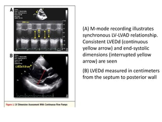 (A) M-mode recording illustrates
synchronous LV-LVAD relationship.
Consistent LVEDd (continuous
yellow arrow) and end-systolic
dimensions (interrupted yellow
arrow) are seen
(B) LVEDd measured in centimeters
from the septum to posterior wall
 