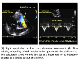 (A) Right ventricular outflow tract diameter assessment. (B) Time
velocity integral by pulsed Doppler in the right ventricular outflow tract.
The calculated stroke volume (86 cc) at a heart rate of 80 beats/min
equates to a cardiac output of 6.8 l/min.
 