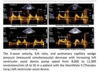 The E-wave velocity, E/A ratio, and pulmonary capillary wedge
pressure (measured simultaneously) decrease with increasing left
ventricular assist device pump speed from 8,000 to 11,000
revolutions/min (A to D) in a patient with the HeartMate II (Thoratec
Corp.) left ventricular assist device.
 