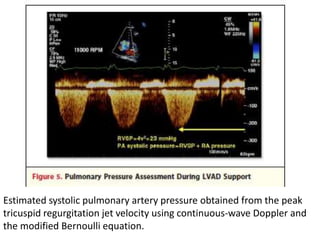 Estimated systolic pulmonary artery pressure obtained from the peak
tricuspid regurgitation jet velocity using continuous-wave Doppler and
the modified Bernoulli equation.
 