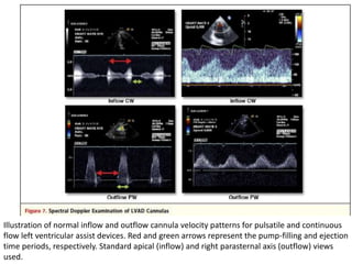 Illustration of normal inflow and outflow cannula velocity patterns for pulsatile and continuous
flow left ventricular assist devices. Red and green arrows represent the pump-filling and ejection
time periods, respectively. Standard apical (inflow) and right parasternal axis (outflow) views
used.
 