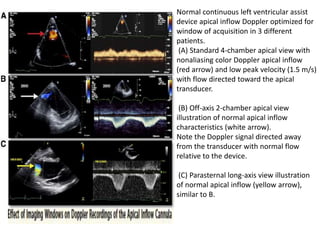 Normal continuous left ventricular assist
device apical inflow Doppler optimized for
window of acquisition in 3 different
patients.
(A) Standard 4-chamber apical view with
nonaliasing color Doppler apical inflow
(red arrow) and low peak velocity (1.5 m/s)
with flow directed toward the apical
transducer.
(B) Off-axis 2-chamber apical view
illustration of normal apical inflow
characteristics (white arrow).
Note the Doppler signal directed away
from the transducer with normal flow
relative to the device.
(C) Parasternal long-axis view illustration
of normal apical inflow (yellow arrow),
similar to B.
 