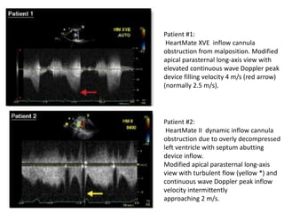 Patient #1:
HeartMate XVE inflow cannula
obstruction from malposition. Modified
apical parasternal long-axis view with
elevated continuous wave Doppler peak
device filling velocity 4 m/s (red arrow)
(normally 2.5 m/s).
Patient #2:
HeartMate II dynamic inflow cannula
obstruction due to overly decompressed
left ventricle with septum abutting
device inflow.
Modified apical parasternal long-axis
view with turbulent flow (yellow *) and
continuous wave Doppler peak inflow
velocity intermittently
approaching 2 m/s.
 