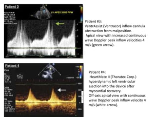 Patient #3:
VentrAssist (Ventracor) inflow cannula
obstruction from malposition.
Apical view with increased continuous
wave Doppler peak inflow velocities 4
m/s (green arrow).
Patient #4:
HeartMate II (Thoratec Corp.)
hyperdynamic left ventricular
ejection into the device after
myocardial recovery.
Off-axis apical view with continuous
wave Doppler peak inflow velocity 4
m/s (white arrow).
 